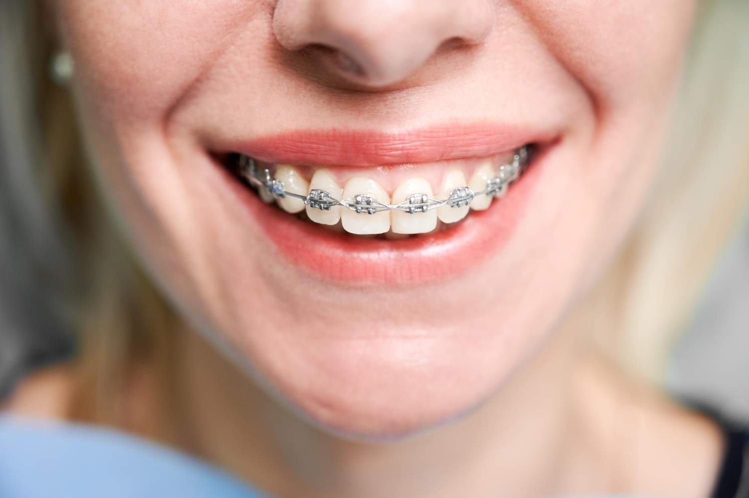 Ortodoncia con brackets metálicos
